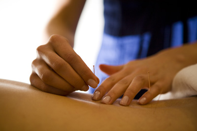 Acupuncture-2 Acupuncture-2