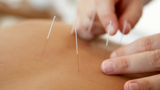 acupuncture therapy needles