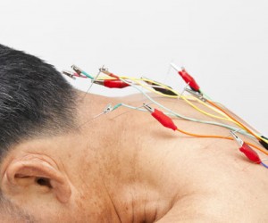 electro acupuncture 300x250 1