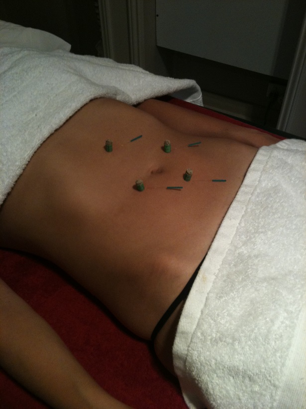 needle moxa belly2a